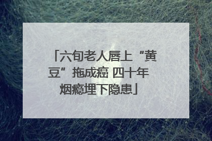 六旬老人唇上“黄豆”拖成癌 四十年烟瘾埋下隐患